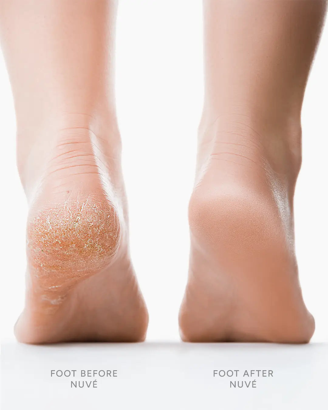 Before and after feet using Nuvé Silk 3 Pro